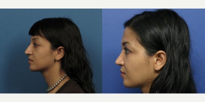 Case 3717 - Woman treated with Rhinoplasty