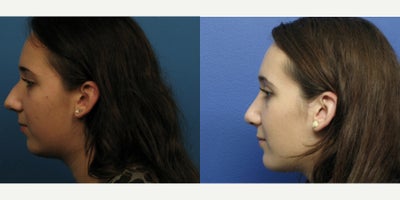 Case 3718 - Woman treated with Rhinoplasty