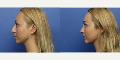 Case 3719 - Woman treated with Rhinoplasty