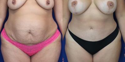 Case 372 - Tummy Tuck