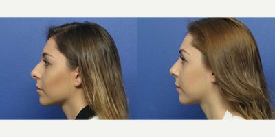 Case 3720 - Woman treated with Rhinoplasty