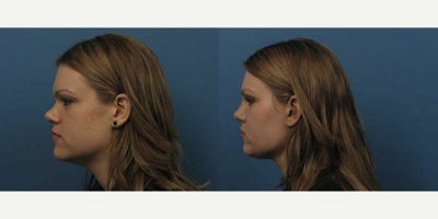 Case 3721 - Woman treated with Rhinoplasty