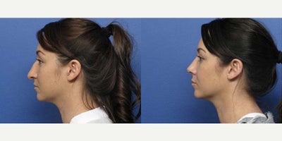 Case 3722 - Woman treated with Rhinoplasty