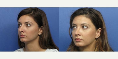Case 3723 - Woman treated with Rhinoplasty