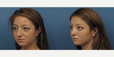 Case 3724 - Woman treated with Rhinoplasty