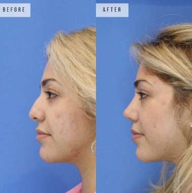 Case 3725 - Woman treated with Rhinoplasty