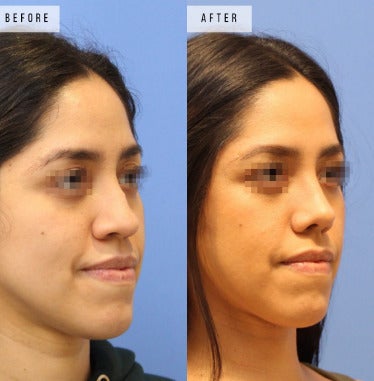 Case 3726 - Woman treated with Rhinoplasty