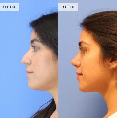 Case 3727 - Woman treated with Rhinoplasty