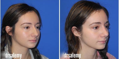 Case 3728 - Woman treated with Rhinoplasty