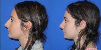 Case 3729 - Woman treated with Rhinoplasty