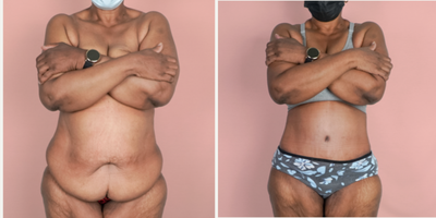 Case 373 - 55-64 year old woman treated with Tummy Tuck, Tumescent Liposuction