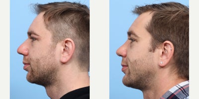 Case 3730 - 35-44 year old man treated with Rhinoplasty, Chin Implant