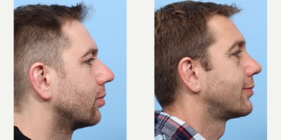 Case 3731 - 35-44 year old man treated with Rhinoplasty, Chin Implant