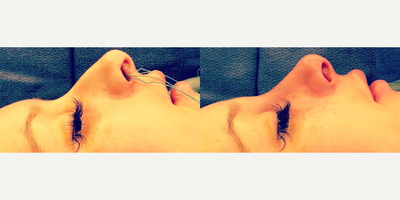 Case 3732 - Woman treated with Rhinoplasty