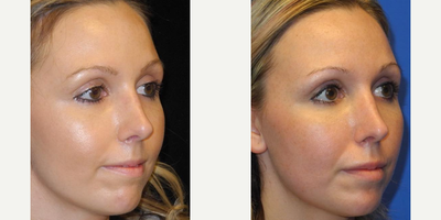 Case 3733 - Woman treated with Rhinoplasty