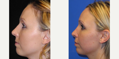 Case 3734 - Woman treated with Rhinoplasty
