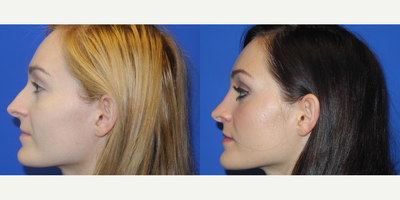 Case 3735 - Woman treated with Rhinoplasty