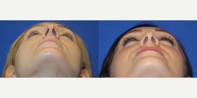 Case 3736 - Woman treated with Rhinoplasty