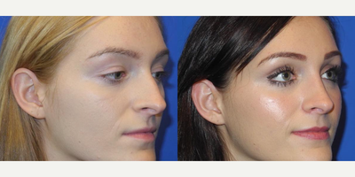 Case 3737 - Woman treated with Rhinoplasty