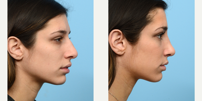Case 3738 - 25-34 year old woman treated with Rhinoplasty