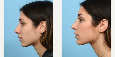 Case 3739 - 25-34 year old woman treated with Rhinoplasty
