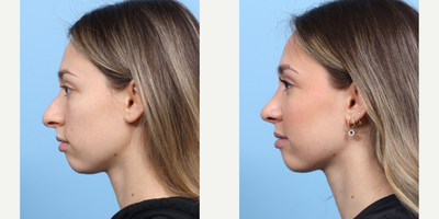 Case 3740 - 18-24 year old woman treated with Rhinoplasty
