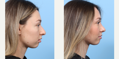 Case 3741 - 18-24 year old woman treated with Rhinoplasty