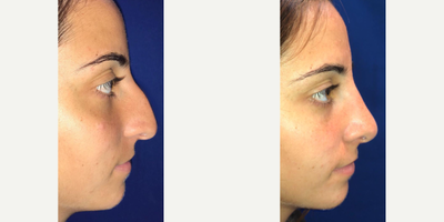 Case 3742 - Woman treated with Rhinoplasty