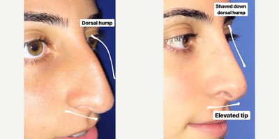 Case 3743 - Woman treated with Rhinoplasty