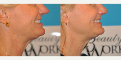 Case 3744 - Woman treated with Rhinoplasty