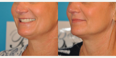 Case 3745 - Woman treated with Rhinoplasty