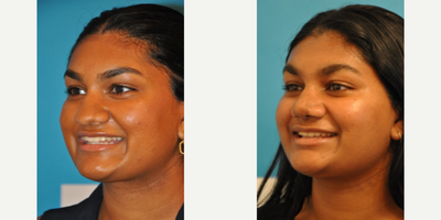 Case 3747 - Teenage Rhinoplasty