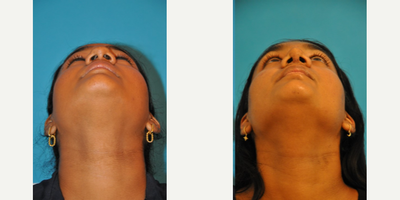 Case 3748 - Teenage Rhinoplasty