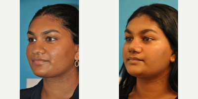 Case 3749 - Teenage Rhinoplasty