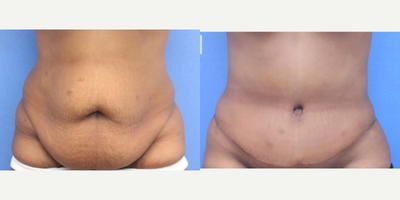 Case 375 - Woman treated with Tummy Tuck