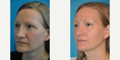 Case 3750 - Woman treated with Rhinoplasty