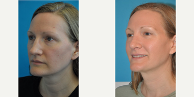 Case 3751 - Woman treated with Rhinoplasty