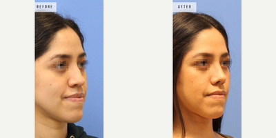 Case 3752 - Woman treated with Rhinoplasty