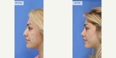 Case 3753 - Woman treated with Rhinoplasty