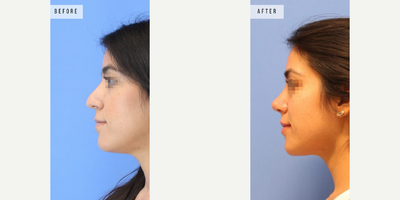 Case 3754 - Woman treated with Rhinoplasty