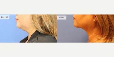 Case 3755 - Woman treated with Rhinoplasty
