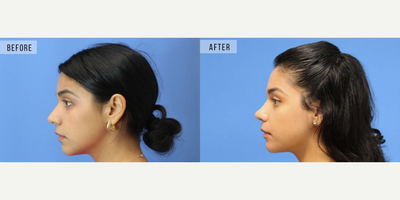 Case 3756 - Woman treated with Rhinoplasty