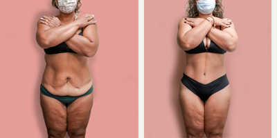 Case 376 - 35-44 year old woman treated with Tummy Tuck