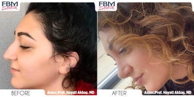 Case 3769 - 25-34 year old woman treated with Rhinoplasty