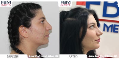 Case 3770 - 18-24 year old woman treated with Rhinoplasty