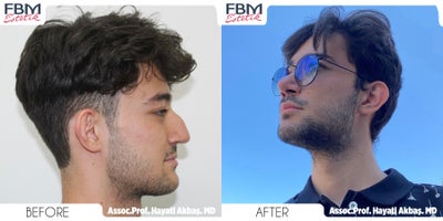 Case 3771 - 18-24 year old man treated with Rhinoplasty