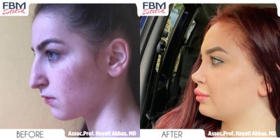 Case 3772 - 18-24 year old woman treated with Rhinoplasty