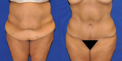 Case 378 - Tummy Tuck