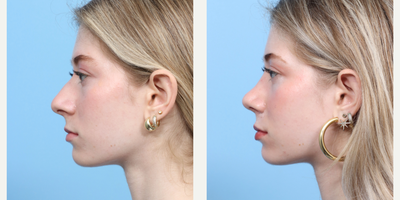 Case 3781 - 18-24 year old woman treated with Rhinoplasty