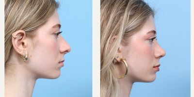 Case 3782 - 18-24 year old woman treated with Rhinoplasty